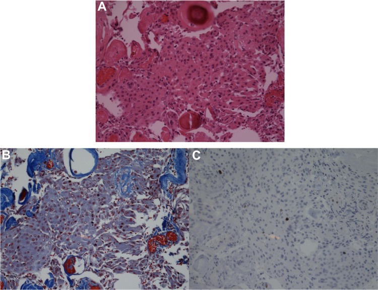 Sphenoid Wing Meningioma Resection — Figure 3