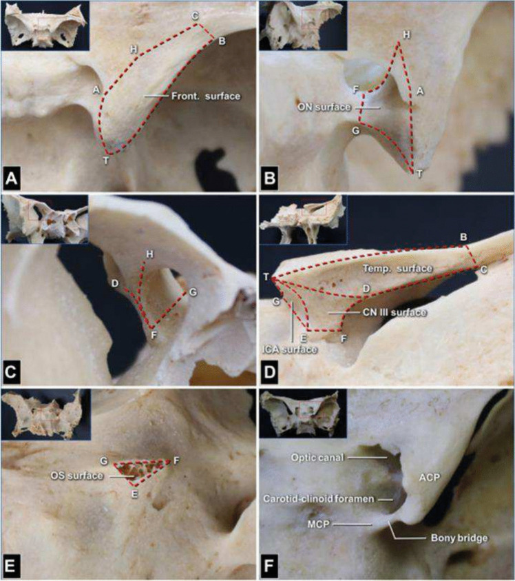 Sphenoid Wing Meningioma Resection — Fig. 1