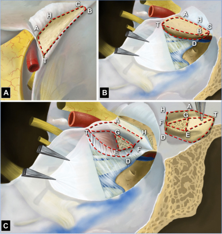 Sphenoid Wing Meningioma Resection — Fig. 2