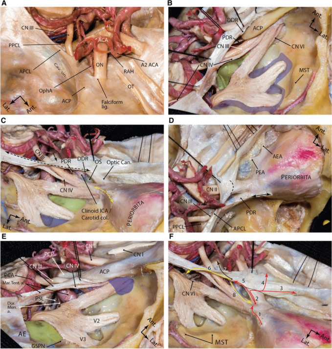 Sphenoid Wing Meningioma Resection — Fig. 3