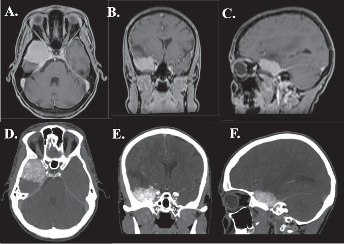 Sphenoid Wing Meningioma Resection — Fig. 4
