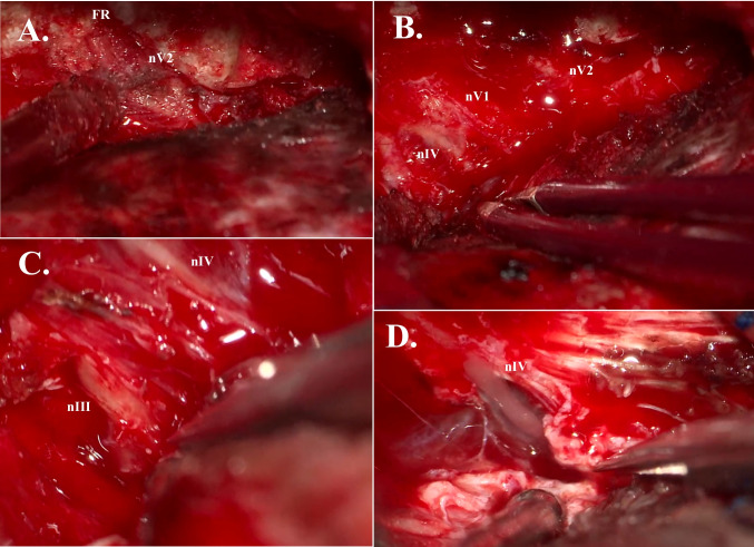 Sphenoid Wing Meningioma Resection — Fig. 5