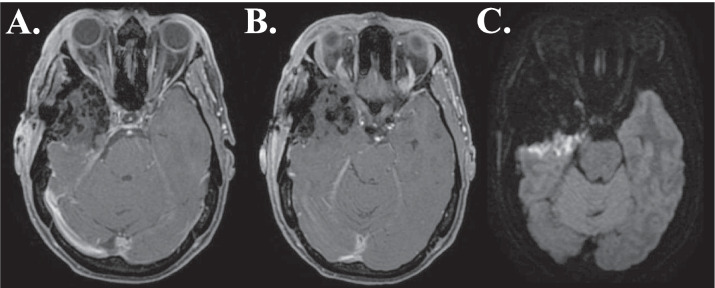 Sphenoid Wing Meningioma Resection — Fig. 6