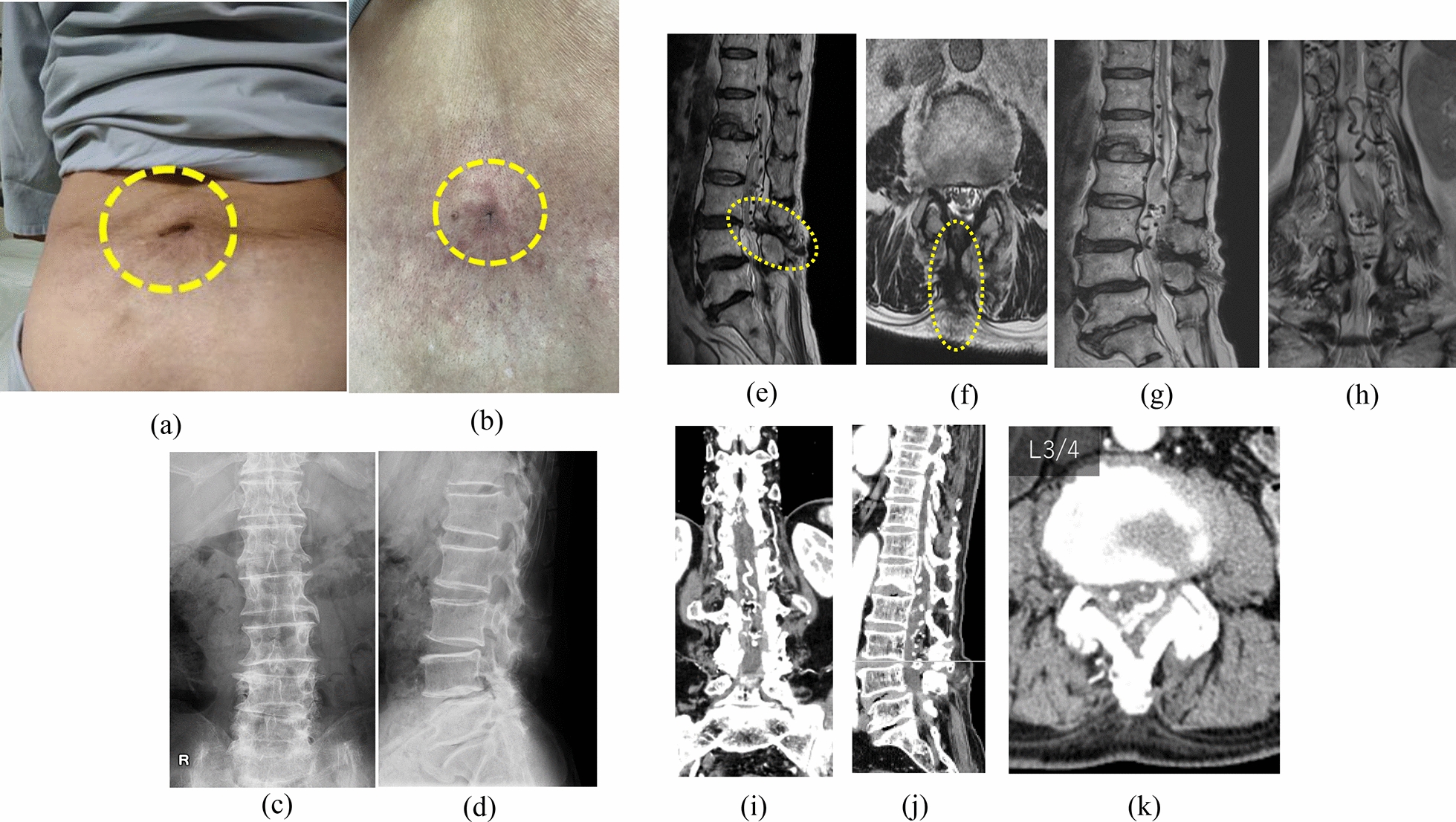Spinal Arteriovenous Malformation — Fig. 1