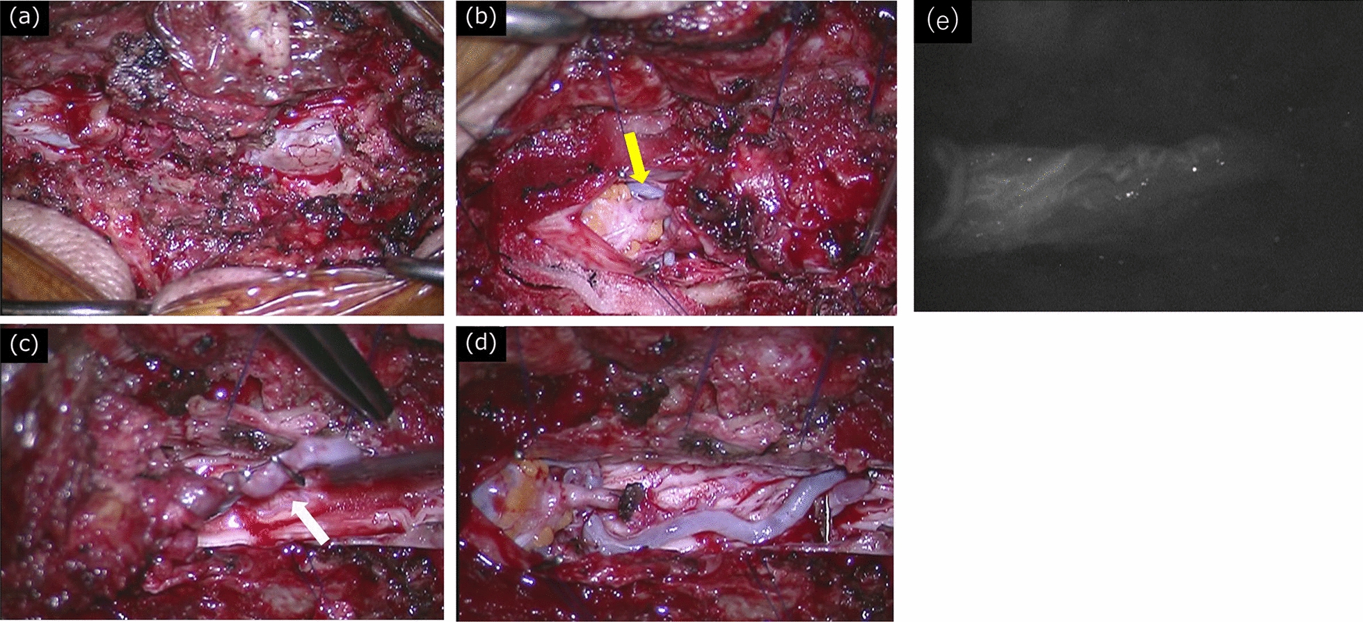 Spinal Arteriovenous Malformation — Fig. 2