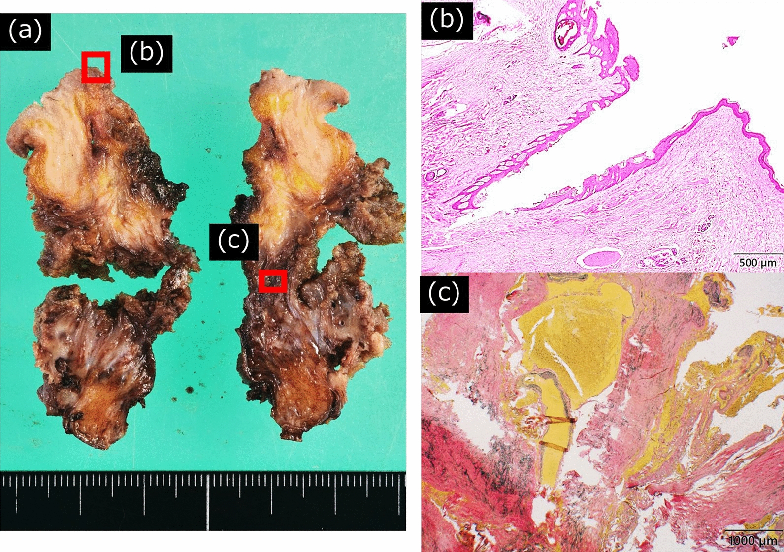 Spinal Arteriovenous Malformation — Fig. 3