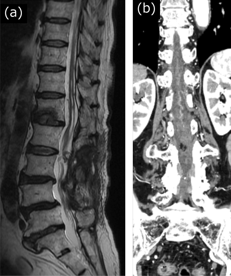 Spinal Arteriovenous Malformation — Fig. 4