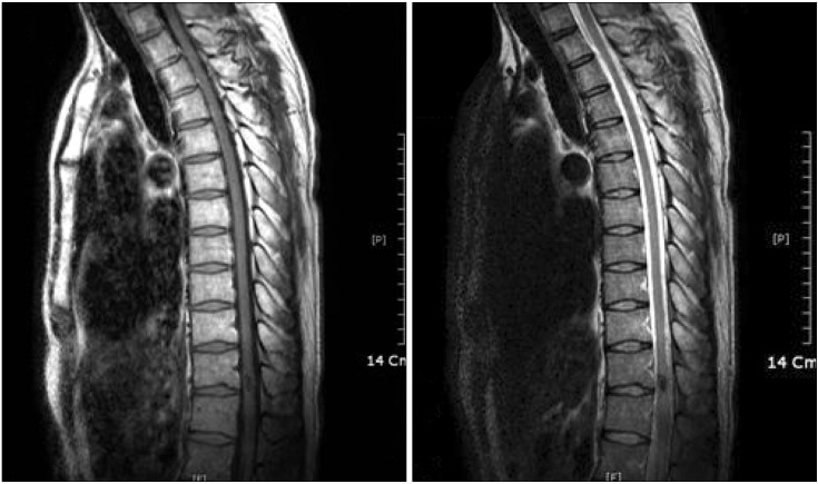 Spinal Arteriovenous Malformation — Fig. 1