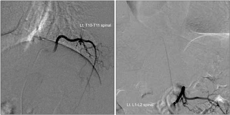 Spinal Arteriovenous Malformation — Fig. 2