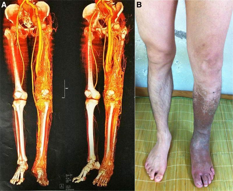 Spinal Arteriovenous Malformation — Figure 1.
