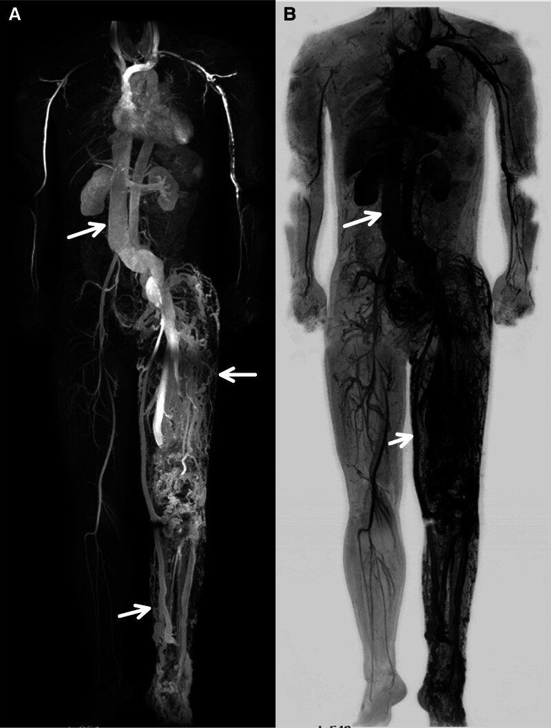 Spinal Arteriovenous Malformation — Figure 2.