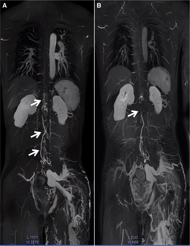 Spinal Arteriovenous Malformation — Figure 3.