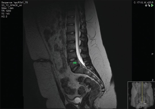 Spinal Arteriovenous Malformation — Figure 1
