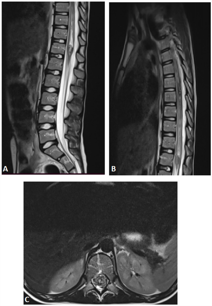 Spinal Cord Cavernous Malformation Resection — Figure 1.