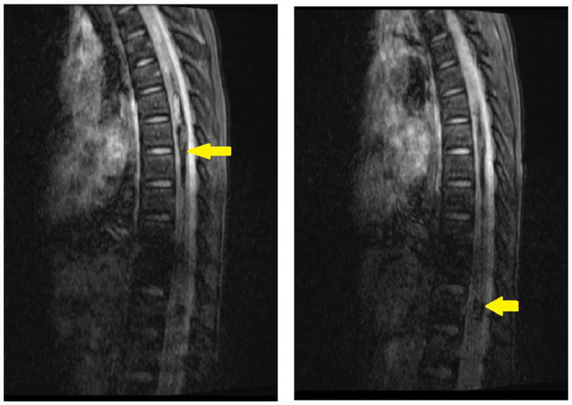 Spinal Cord Cavernous Malformation Resection — Figure 2.