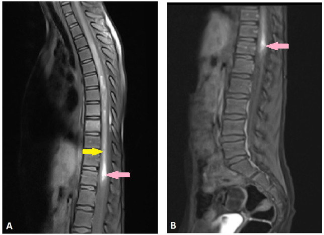 Spinal Cord Cavernous Malformation Resection — Figure 3.