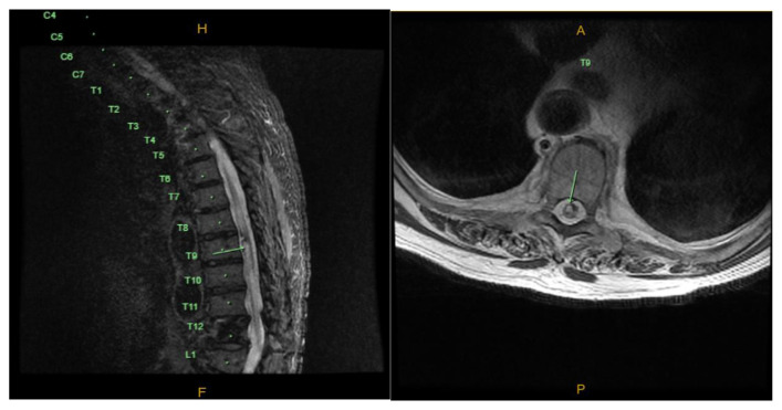 Spinal Cord Cavernous Malformation Resection — Fig. 1