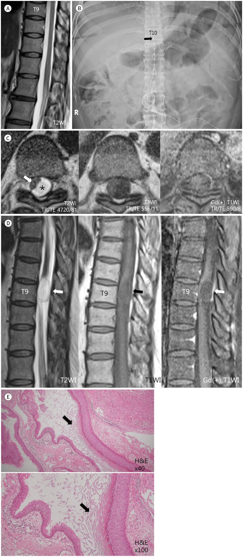 Spinal Cord Stimulator Placement — Fig. 1