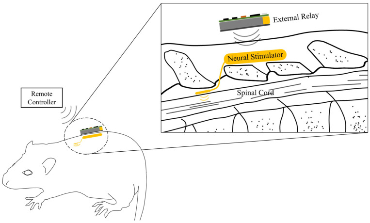 Spinal Cord Stimulator Placement — Figure 1
