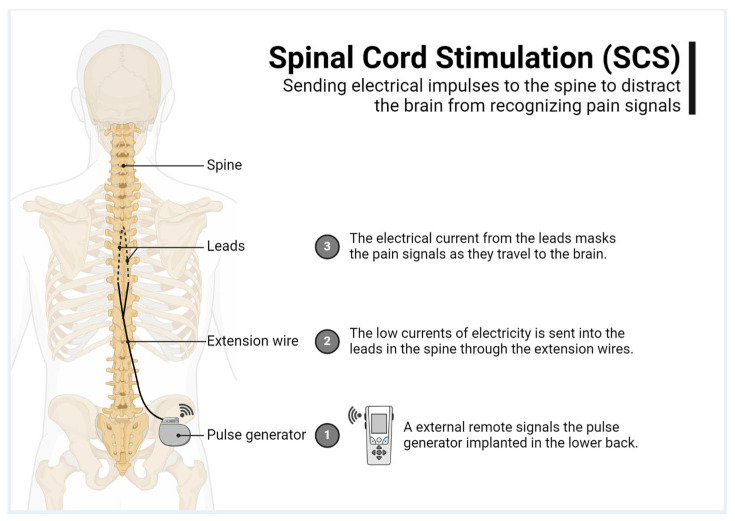 Spinal Cord Stimulator Placement — Figure 1