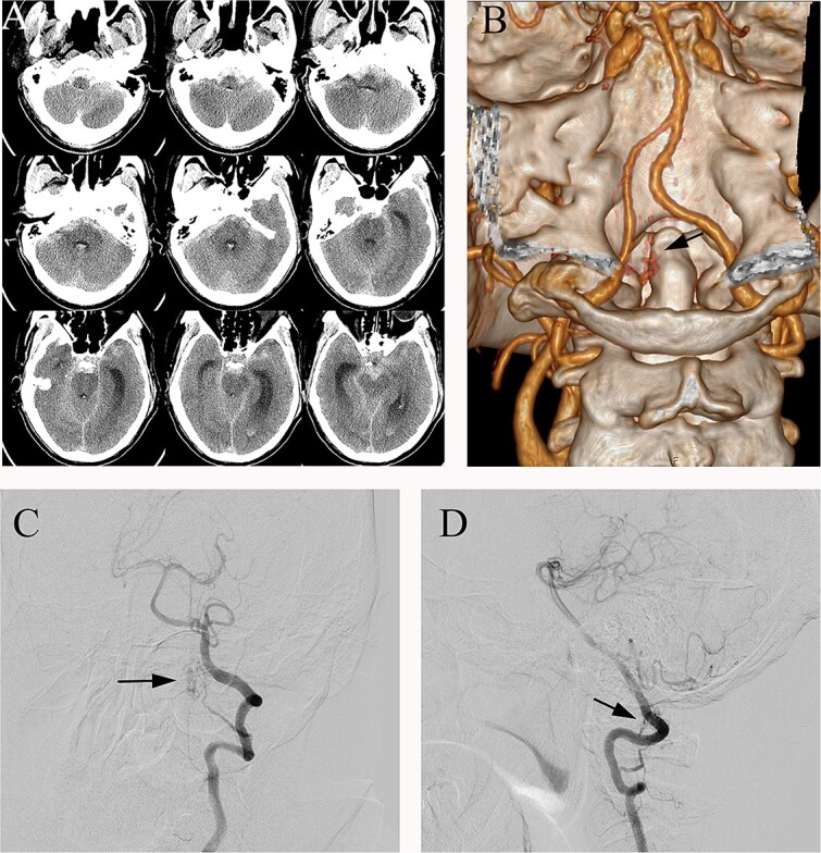 Spinal Dural Arteriovenous Fistula Surgical Ligation — Figure 1