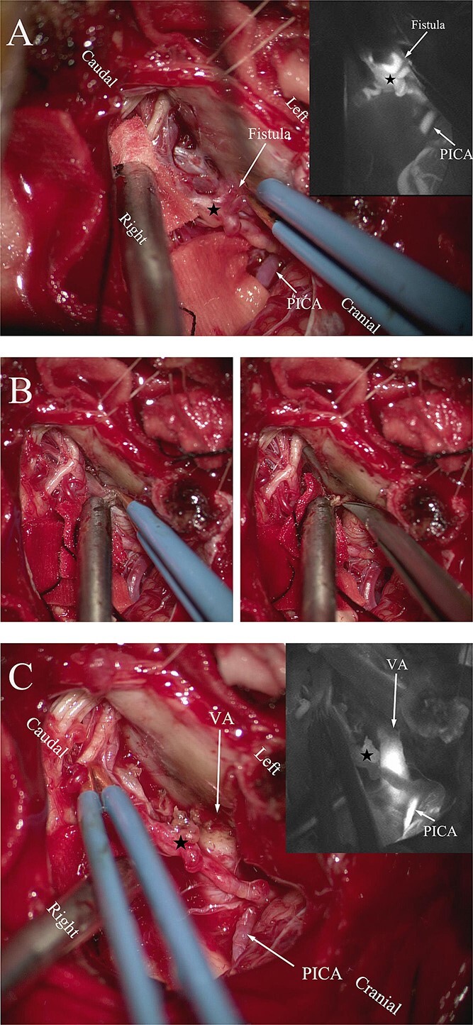 Spinal Dural Arteriovenous Fistula Surgical Ligation — Figure 2