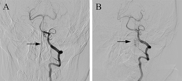 Spinal Dural Arteriovenous Fistula Surgical Ligation — Figure 3