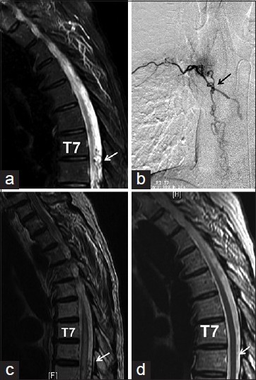 Spinal Dural Arteriovenous Fistula Surgical Ligation — Figure 1