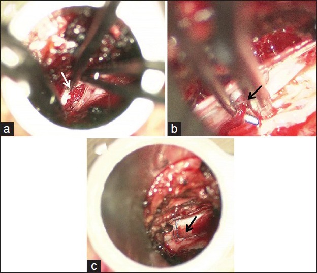 Spinal Dural Arteriovenous Fistula Surgical Ligation — Figure 2