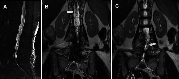 Spinal Dural Arteriovenous Fistula Surgical Ligation — FIG. 1