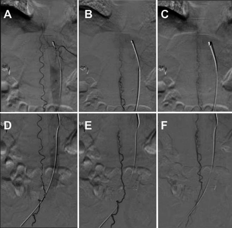 Spinal Dural Arteriovenous Fistula Surgical Ligation — FIG. 2