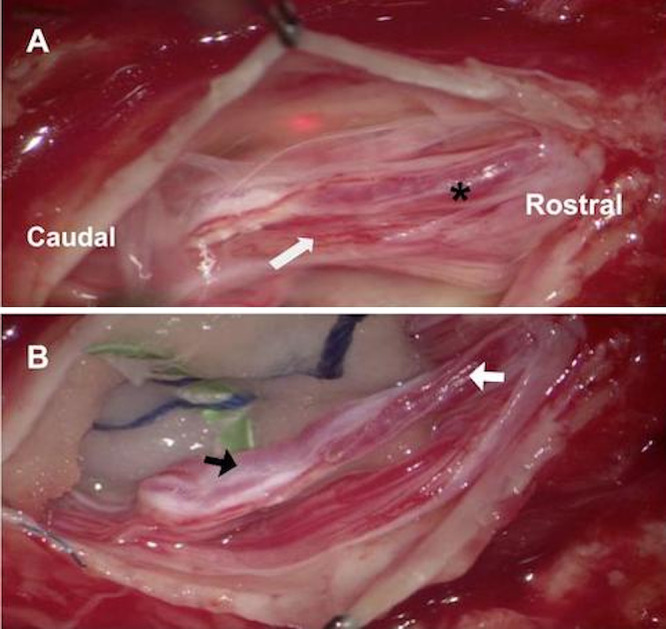 Spinal Dural Arteriovenous Fistula Surgical Ligation — FIG. 3