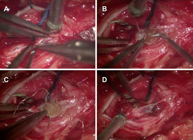 Spinal Dural Arteriovenous Fistula Surgical Ligation — FIG. 4