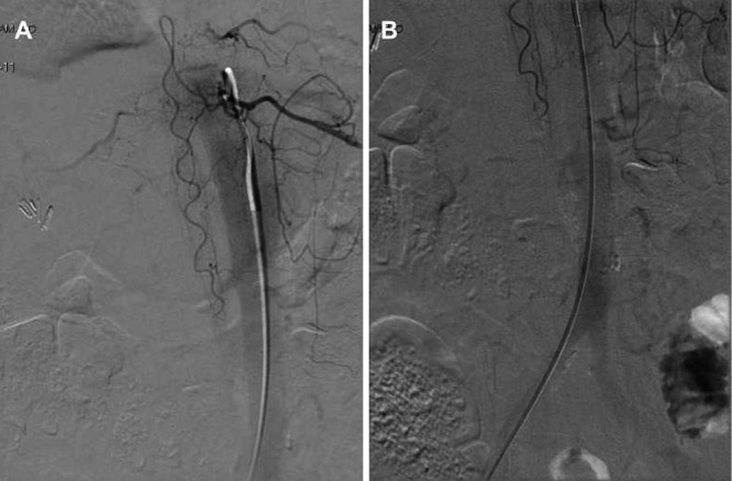 Spinal Dural Arteriovenous Fistula Surgical Ligation — FIG. 5