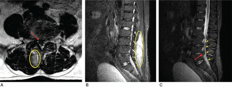 Spinal Epidural Abscess Decompression & Drainage — Figure 1