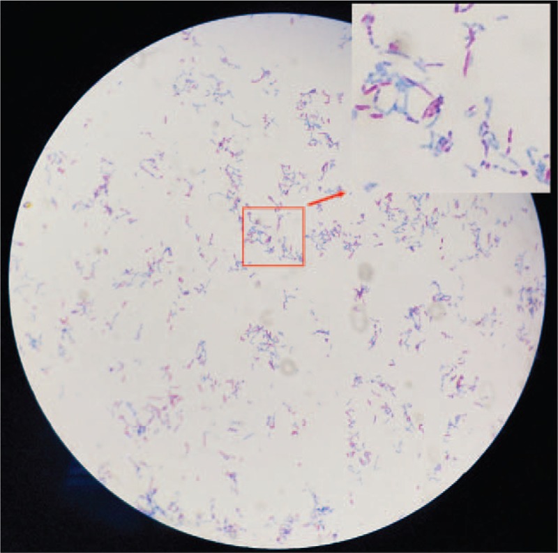 Spinal Epidural Abscess Decompression & Drainage — Figure 3