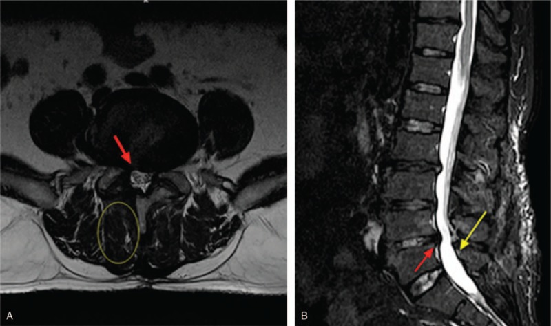 Spinal Epidural Abscess Decompression & Drainage — Figure 5