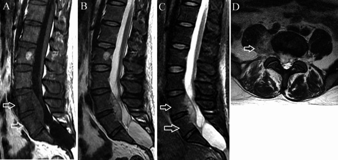 Spinal Epidural Abscess Decompression & Drainage — Fig. 1