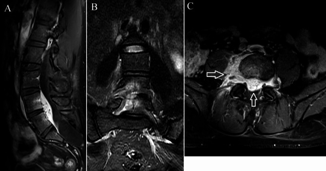Spinal Epidural Abscess Decompression & Drainage — Fig. 2