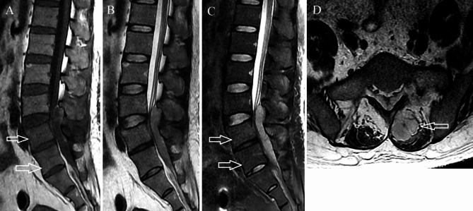 Spinal Epidural Abscess Decompression & Drainage — Fig. 3