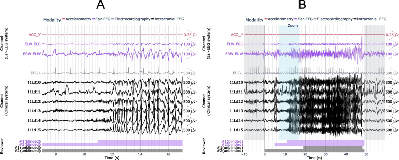 Stereo-EEG Depth Electrode Placement — Fig. 3