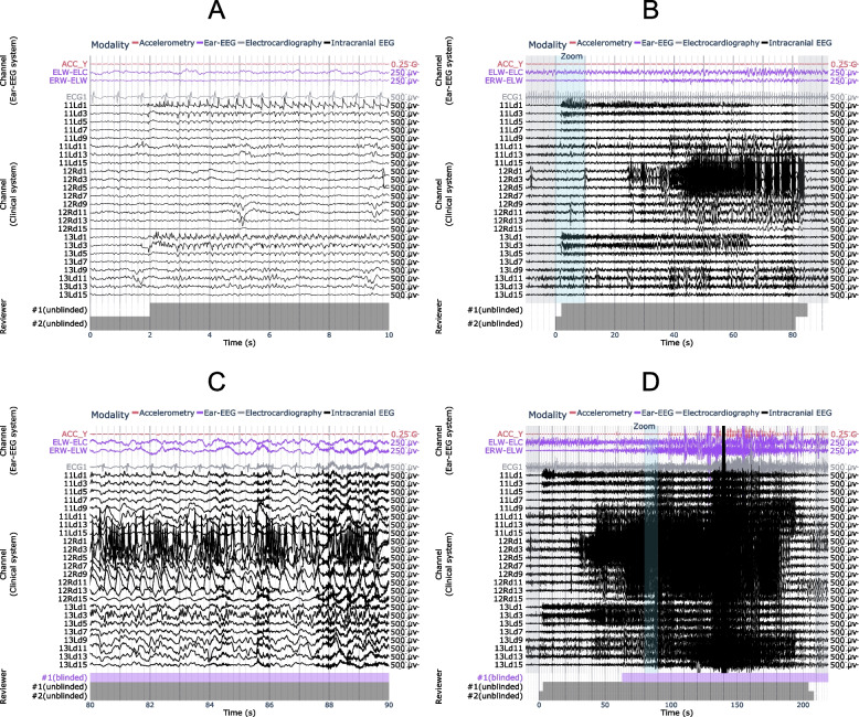 Stereo-EEG Depth Electrode Placement — Fig. 5