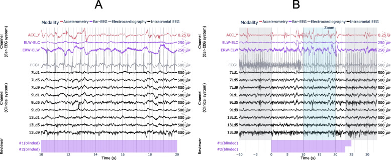 Stereo-EEG Depth Electrode Placement — Fig. 6