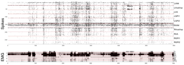 Stereo-EEG Depth Electrode Placement — Figure 2