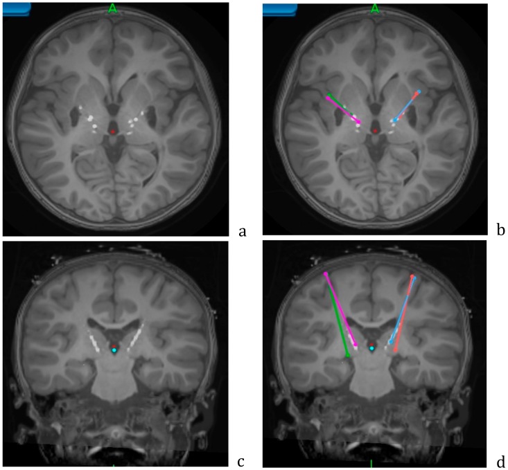 Stereo-EEG Depth Electrode Placement — Figure 4