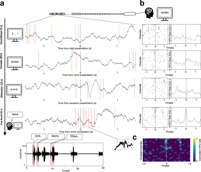 Stereo-EEG Depth Electrode Placement — Fig. 1