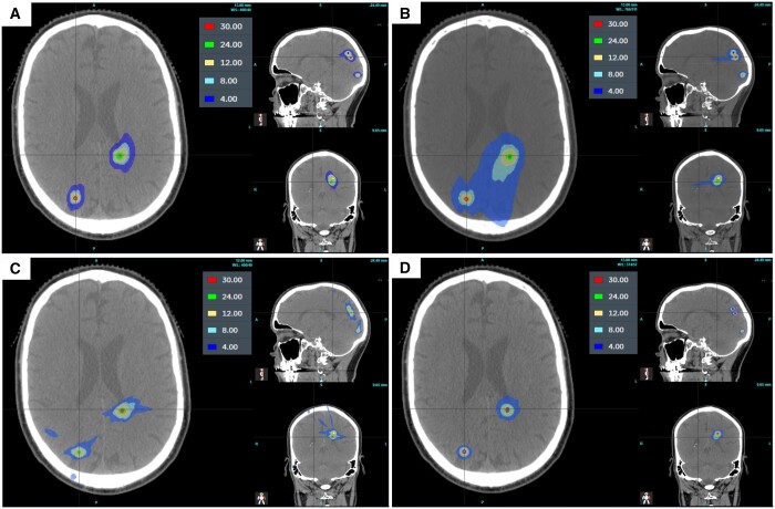 Stereotactic Radiosurgery Gamma Knife LINAC CyberKnife — Figure 2.