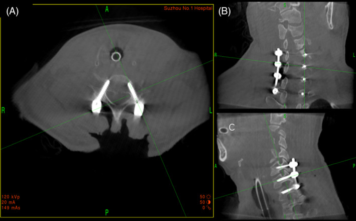 Subaxial Cervical Spine Fracture Dislocation Fixation — Fig. 4