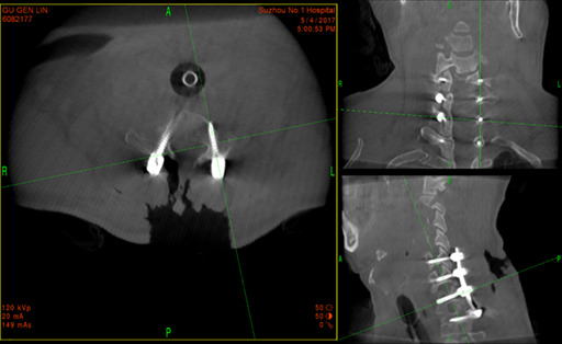 Subaxial Cervical Spine Fracture Dislocation Fixation — Figure 2