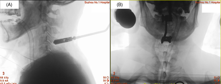 Subaxial Cervical Spine Fracture Dislocation Fixation — Fig. 3